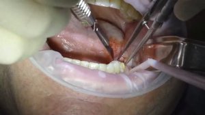 Удаление зуба 37