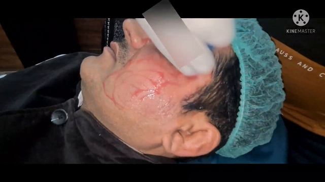 PRP FACE/BLOOD FACIAL/VAMPIRE FACELIFT @DesignerDoctor #prp #prpfacial #acnescars #antiaging смотреть онлайн