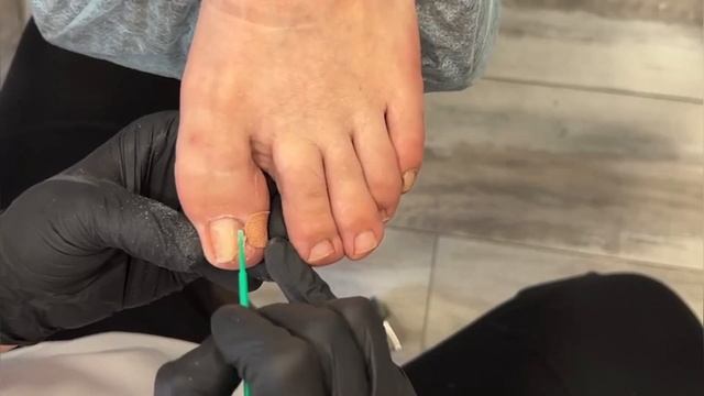 Установка титановой нити смотреть онлайн