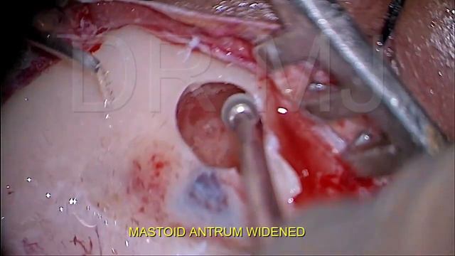 RIGHT COCHLEAR IMPLANTATION IN AN EXTREMELY FORWARD LYING SIGMOID SINUS WITH SUPERIOR MASTOID ANTRU смотреть онлайн