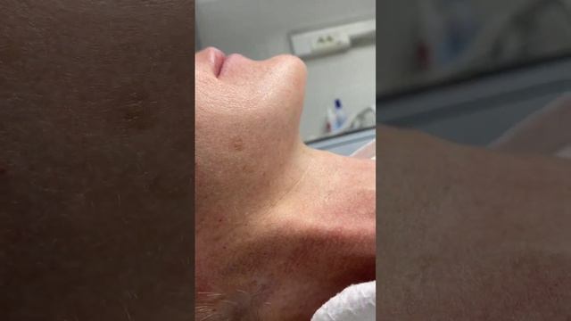 Подтяжка лица без синяков и отёков смотреть онлайн