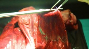 Резекция верхушки легкого