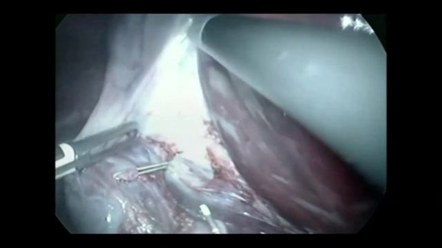 Лапароскопическая холецистэтомия смотреть онлайн