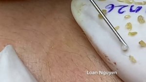 Removal blackheads and whiteheads (n26)