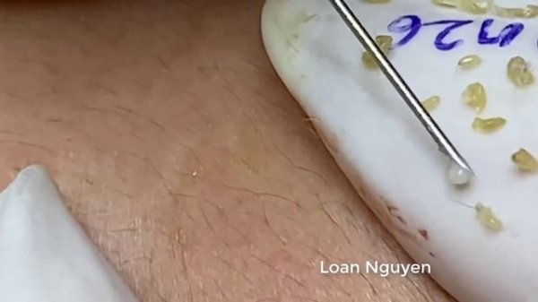 Removal blackheads and whiteheads (n26)