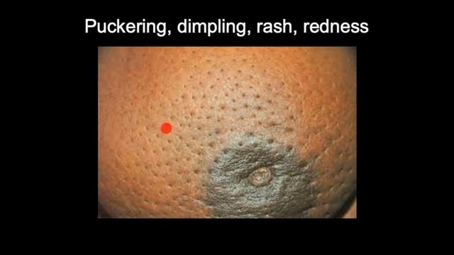 7 warning signs and symptoms of BREAST CANCER... Doctor O'Donovan explains смотреть онлайн