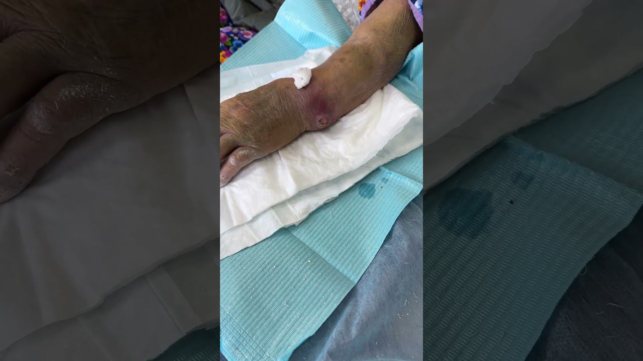 ПРОЛЕЖНИ ПОД ГИПСОМ | Перелом лучевой кости смотреть онлайн