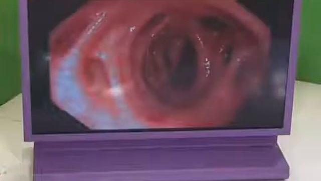 О самом главном: пяточные шпоры, цитокинотерапия, растяжение кишечника