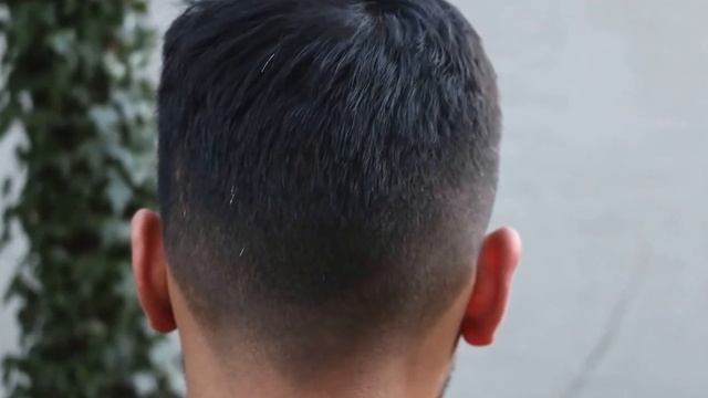 Пересадка 2500гр мужчине в Турции - Клиника HLC смотреть онлайн