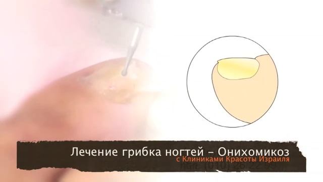 Лечение ногтевого грибка - Онихомекоз смотреть онлайн