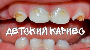 КАРИЕС У ДЕТЕЙ ОТ 1 ГОДА | ГИГИЕНА ПЕРВЫХ ЗУБОВ | ПОЧЕМУ РАЗРУШАЮТСЯ ЗУБКИ?