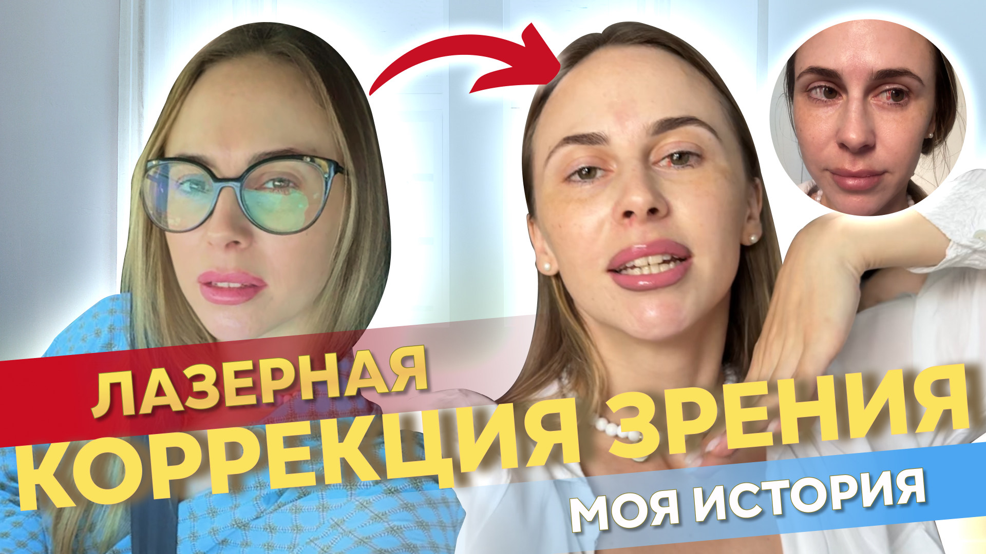 Лазерная коррекция зрения | femto lasik, smile I Как прошла лазерная коррекция зрения | довольна ли смотреть онлайн