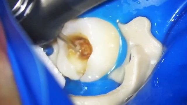 Лечение кариеса , сверлим кариес , постановка пломбы , лечение зубов , какая пломба лучше , кариес смотреть онлайн