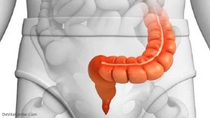 ВОСПАЛЕНИЕ СИГМОВИДНОЙ КИШКИ  -  как лечить?