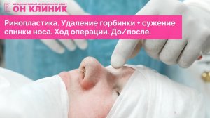 Ринопластика. Удаление горбинки + сужение спинки носа. Ход операции. До/после.
