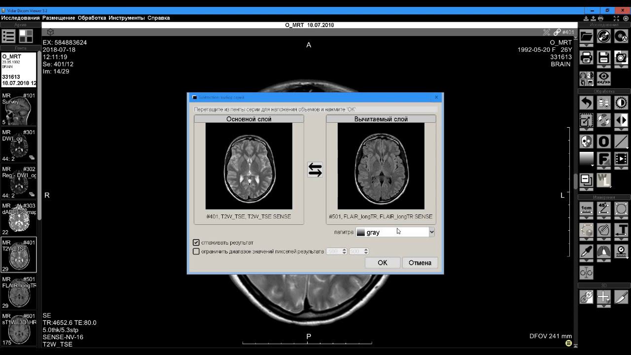 Наложение изображений в Vidar Dicom Viewer смотреть онлайн