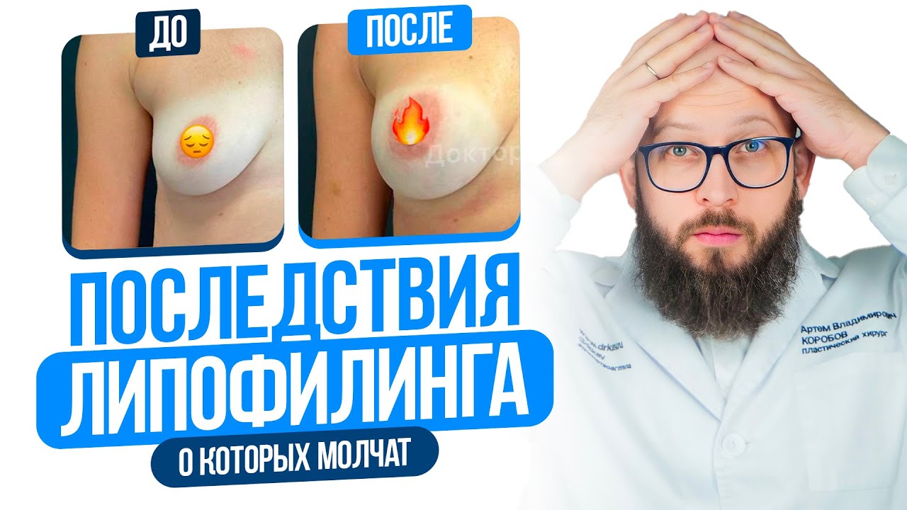 НЕ ДЕЛАЙТЕ ЛИПОФИЛИНГ, пока не узнаете об этих последствиях! Вся правда о Липофилинге. смотреть онлайн