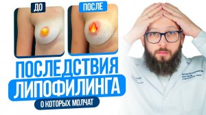 НЕ ДЕЛАЙТЕ ЛИПОФИЛИНГ, пока не узнаете об этих последствиях! Вся правда о Липофилинге.