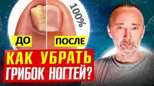 Как избавиться от грибка ногтей и стоп на 100%?
