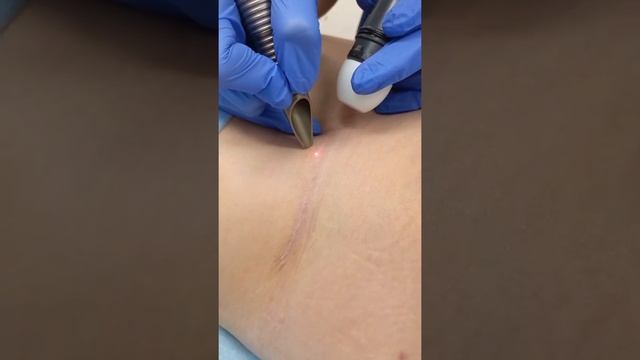 Шлифовка рубца после абдоминопластики смотреть онлайн