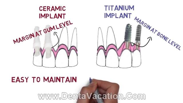 Zirconia Vs. Titanium Dental Implants смотреть онлайн