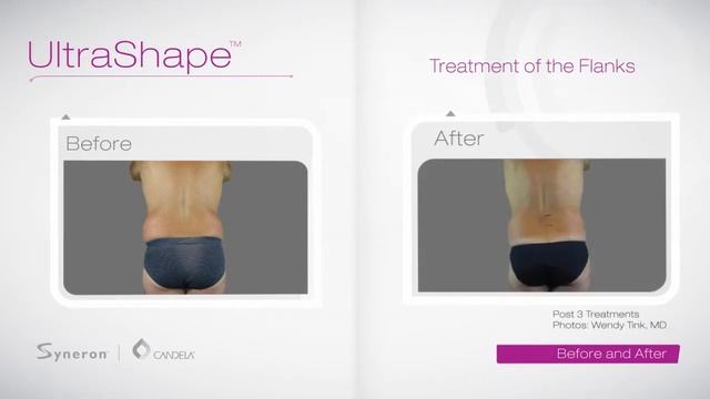 Ультразвуковая липосакция UltraShape в клинике Оксфорд Медикал в Киеве смотреть онлайн