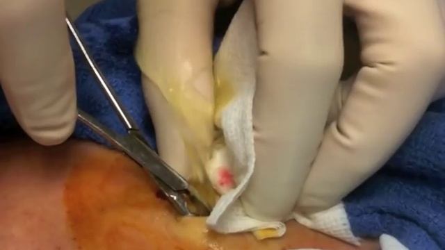 Seroma aspiration & drain insertion after lymph node excision смотреть онлайн