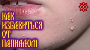 КАК ИЗБАВИТЬСЯ ОТ ПАПИЛЛОМ. Народные Средства для Лечения и Удаления Папиллом.mp4