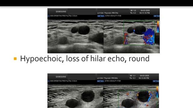 USG and Color Doppler of Normal, Inflammatory, TB and Neoplastic Lymph nodes .Dr. Prashant Onkar смотреть онлайн