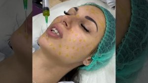 Пилинг BioRePeelCl3 (биорепил)