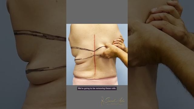 Breast Implant Removal , Dermal Bra Suspension Breast Lift, Upper Body lift, & Breast Augmentation смотреть онлайн