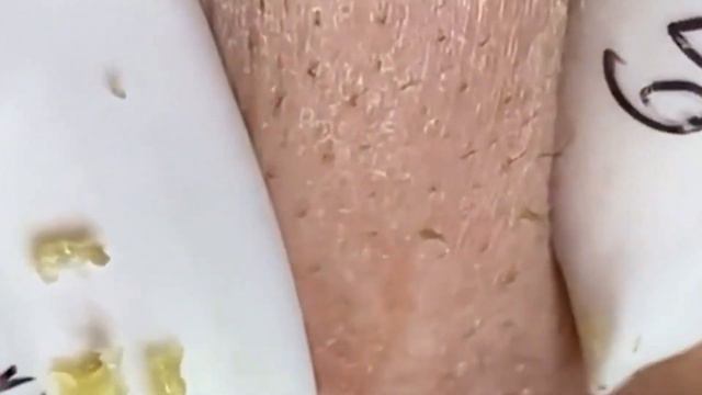 Прыщи / Огромные прыщи / Релакс с акне / Выдавливание прыщей / Черная точка  #Прыщи