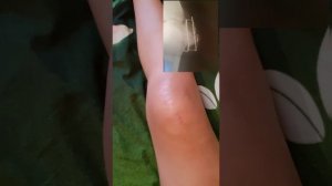 Перелом надколенника со смещением. Часть 2. Перелом ноги . Перелом колена. Остеосинтез надколенника