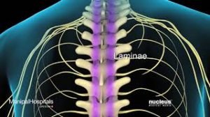 Спинальный стеноз (стеноз позвоночного канала).