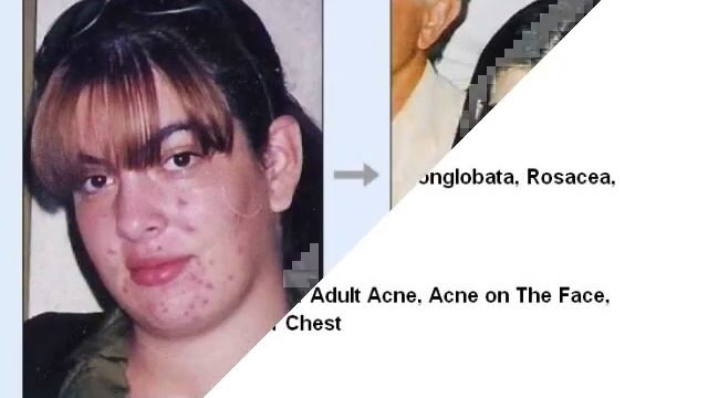laser resurfacing acne scars - you can do it! смотреть онлайн
