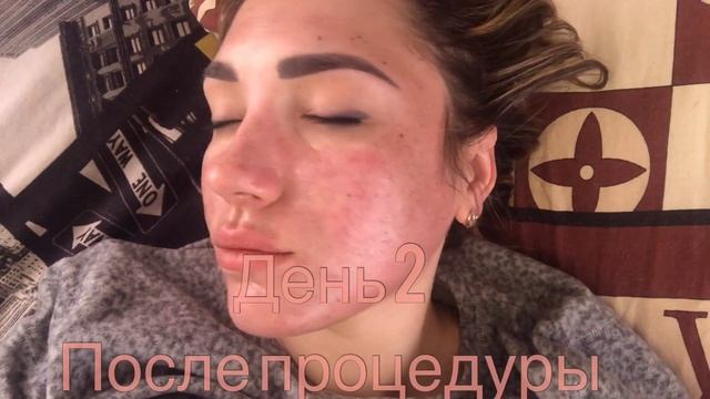 ГЛУБОКИЙ ПИЛИНГ ДЖЕССНЕРА/ 6 СЛОЕВ / ПЕРВЫЕ 3 ДНЯ смотреть онлайн