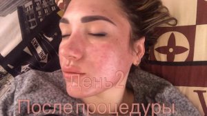 ГЛУБОКИЙ ПИЛИНГ ДЖЕССНЕРА/ 6 СЛОЕВ / ПЕРВЫЕ 3 ДНЯ