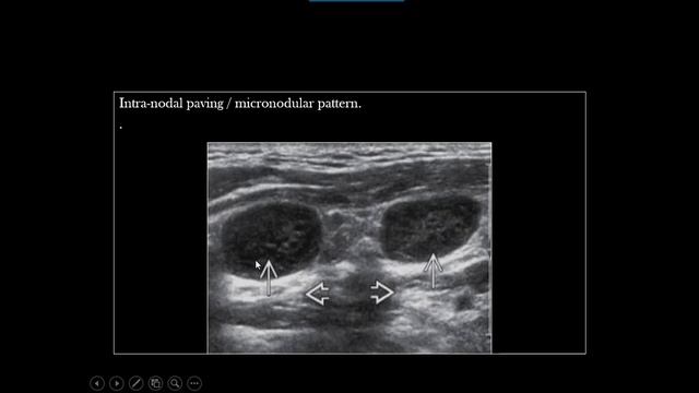 Ultrasound Case 20 - Lymphomatous Lymph Nodes (Web case) смотреть онлайн