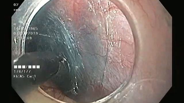 Diagnostic and treatment GI endoscopy with Aleksandr Kiosov - Leyomioma Esophagus STER смотреть онлайн