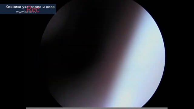 Диагностика  Септопластика