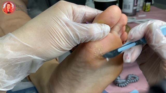 Бородавки на стопе / удаление азотной кислотой / выжигание смотреть онлайн