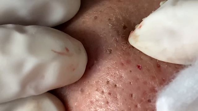 Make your Acne Treatment Huong Da Nang#496 | acne 2022 Part3 смотреть онлайн