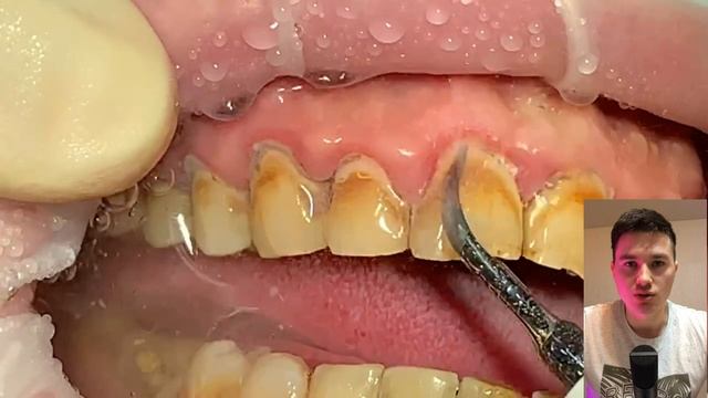 Как убрать зубной камень в домашних условиях смотреть онлайн