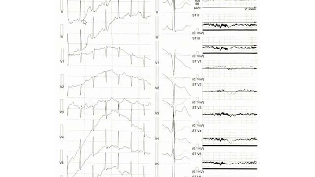 WPW и смещение сегмента ST на ЭКГ смотреть онлайн
