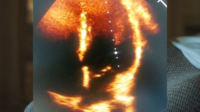 Prolapso valvular mitral. смотреть онлайн