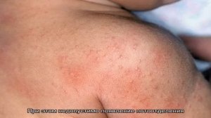 Как отличить потницу на лице у ребенка от аллергии: описание признаков, фото. Как избавиться от по.