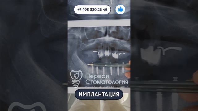 Имплантация зубов пациенту. История пациента. смотреть онлайн