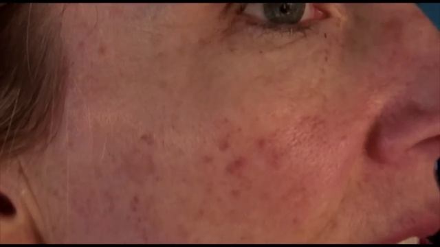 Before & After IPL Photofacial ~ Results 1st Treatment ~ Over 50 смотреть онлайн