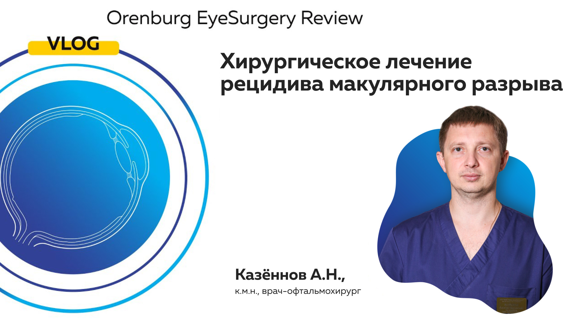 Хирургическое лечение рецидива макулярного разрыва