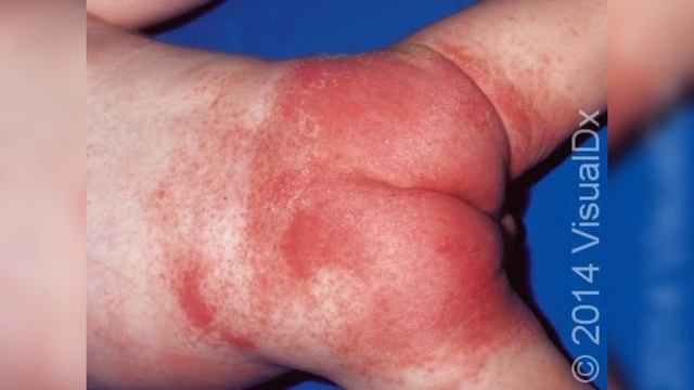 Жөргектік/Пеленочный дерматит.Баланың көтені қызаруы смотреть онлайн